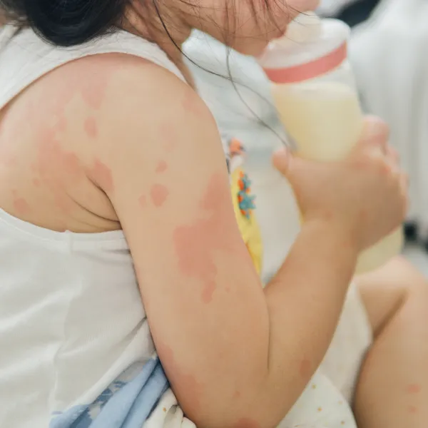 Bebeklerde Alerji Gerçeği! Yanlış Bildikleriniz Şok Edecek