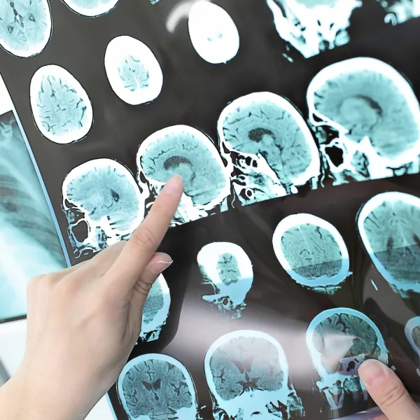 Nörolojik hastalıklarda kök hücre tedavisi deneysel aşamada